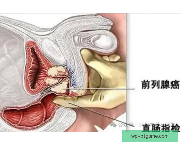 爱尔兰足球名将克里斯休顿坦诚确诊前列腺癌心路历程